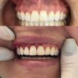 Gengivoplastia
