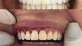 Gengivoplastia