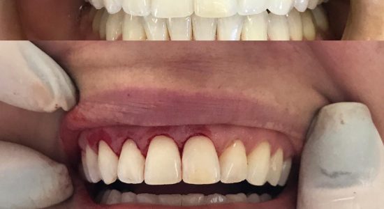 Gengivoplastia